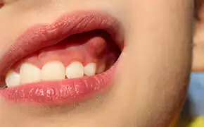 粘膜疾患