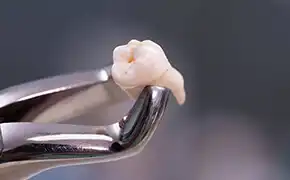 歯牙移植